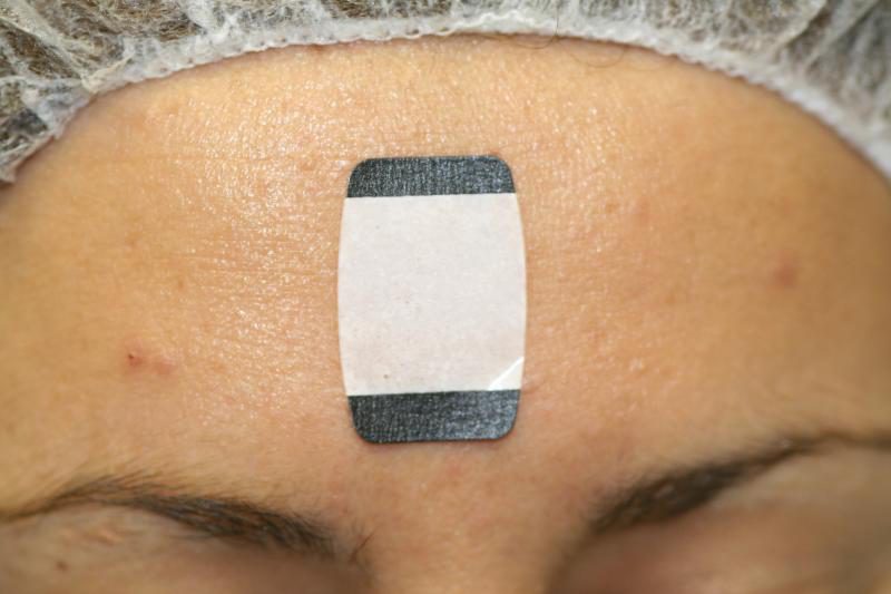 Sebutape patch applied to the forehead