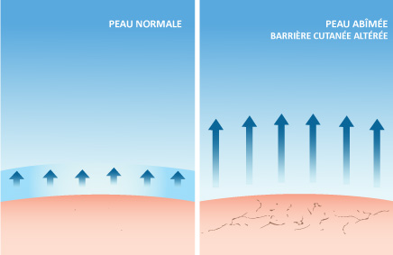 Normal skin vs Damaged skin / Altered cutaneous barrier