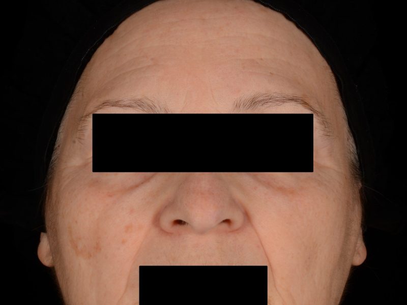 Cross Polarized (CP)