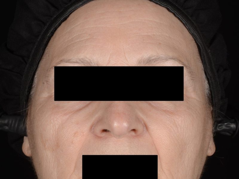 Parallel Polarised (PP)